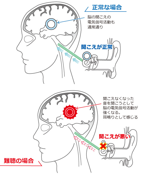 22액자3_난청인 뇌의 이상반응_난청인의 이명발생 매커니즘.png